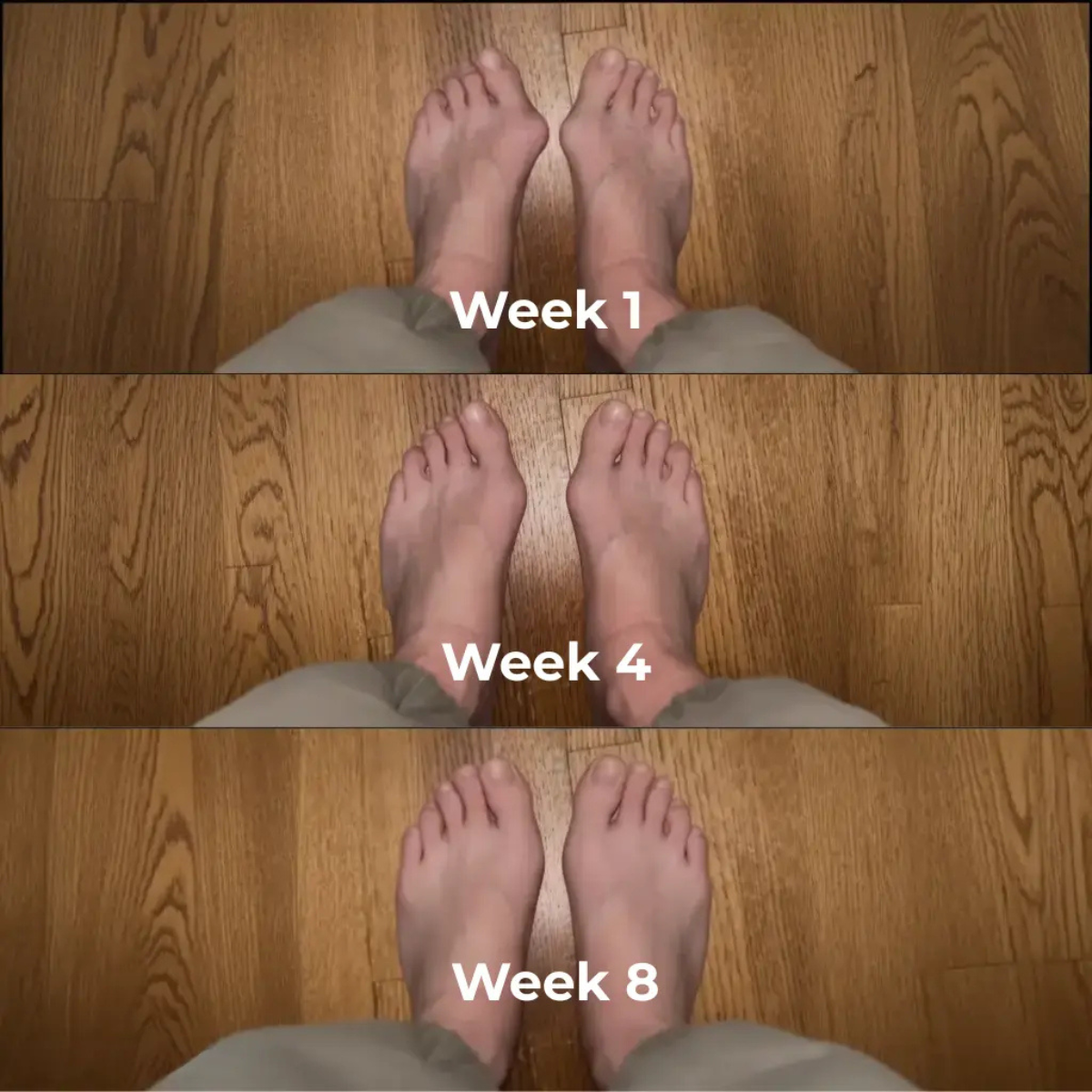 Aligna - För ökad komfort vid hallux valgus