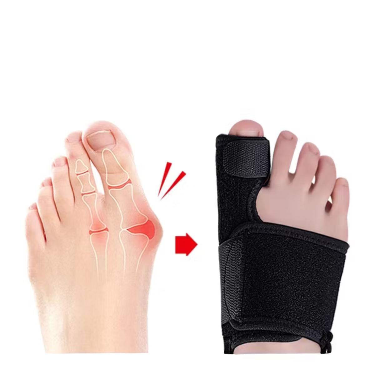Aligna - För ökad komfort vid hallux valgus